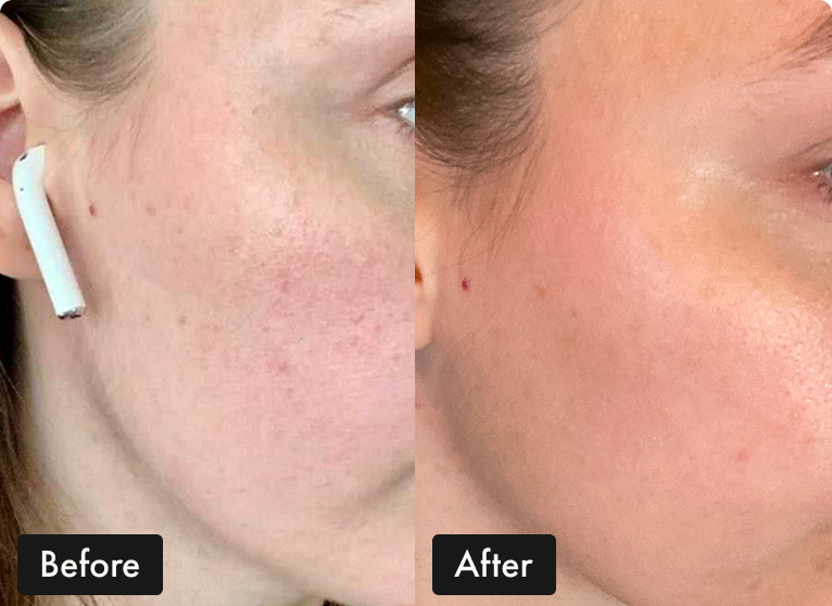 A before and after side-by-side comparison of a woman's cheek showing a reduction in redness and blemishes.