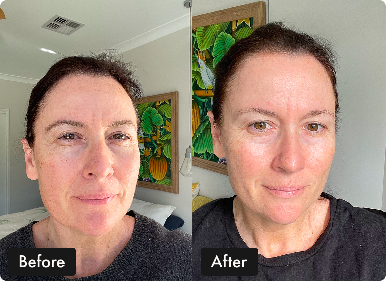 A side-by-side image of a woman's face, labeled 'Before' and 'After,' showing improved skin appearance.