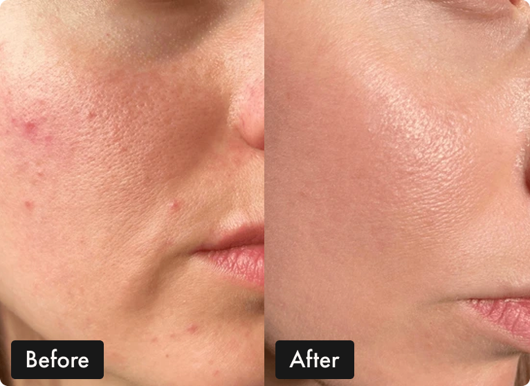 A before-and-after close-up of a person's cheek, showing a reduction in redness, acne, and visible pores.