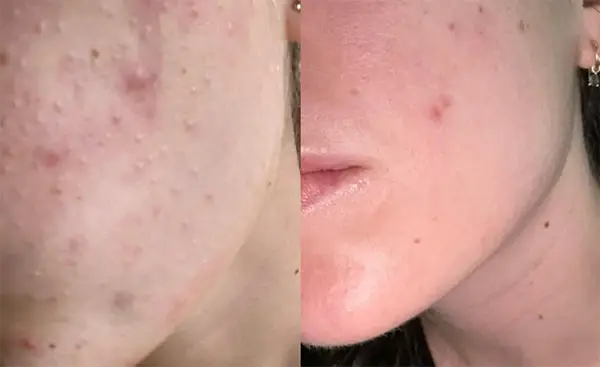 Side-by-side comparison of acne-prone skin before and after treatment.