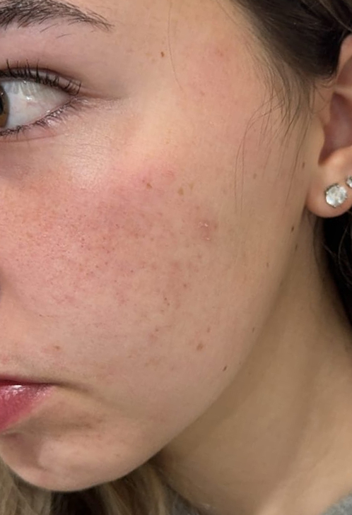 Close-up of a person's cheek with visible pores and earrings.