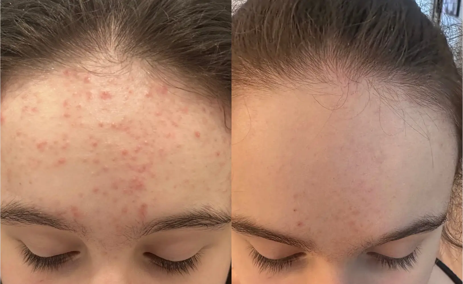 Two images of a forehead, one with acne and one without.