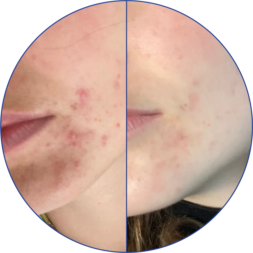 Side-by-side image showing facial skin with and without acne.