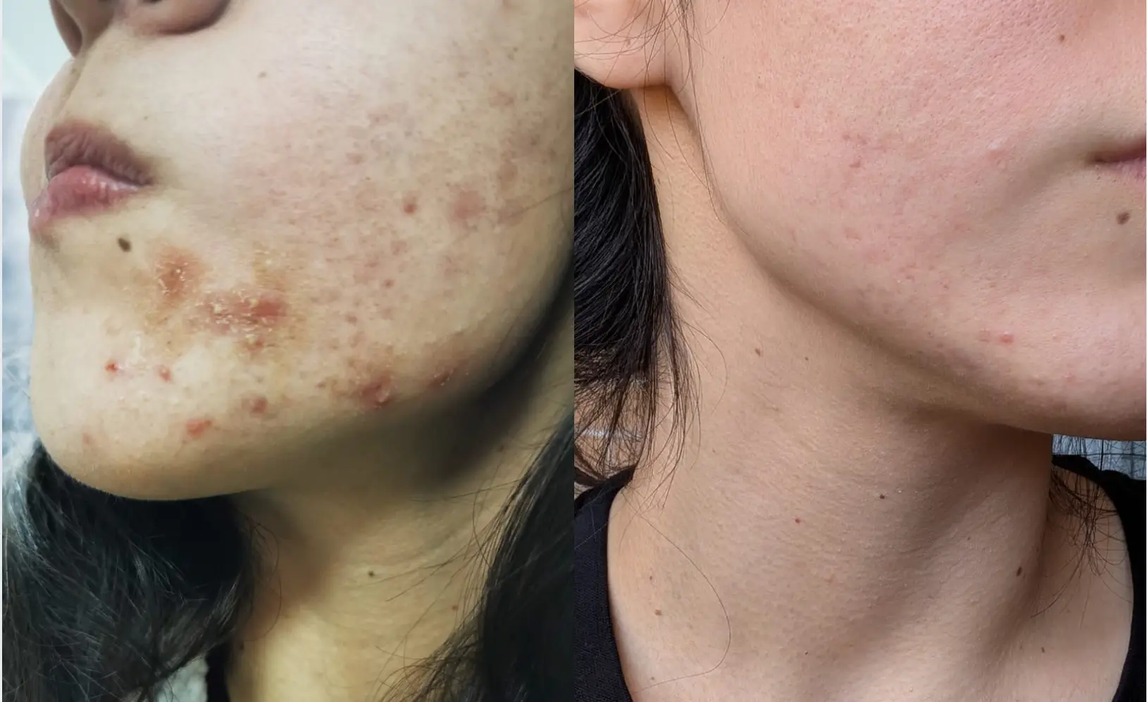 Side-by-side comparison of a face with and without skin blemishes.