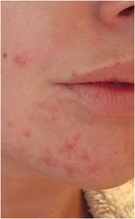 Skin Care Before