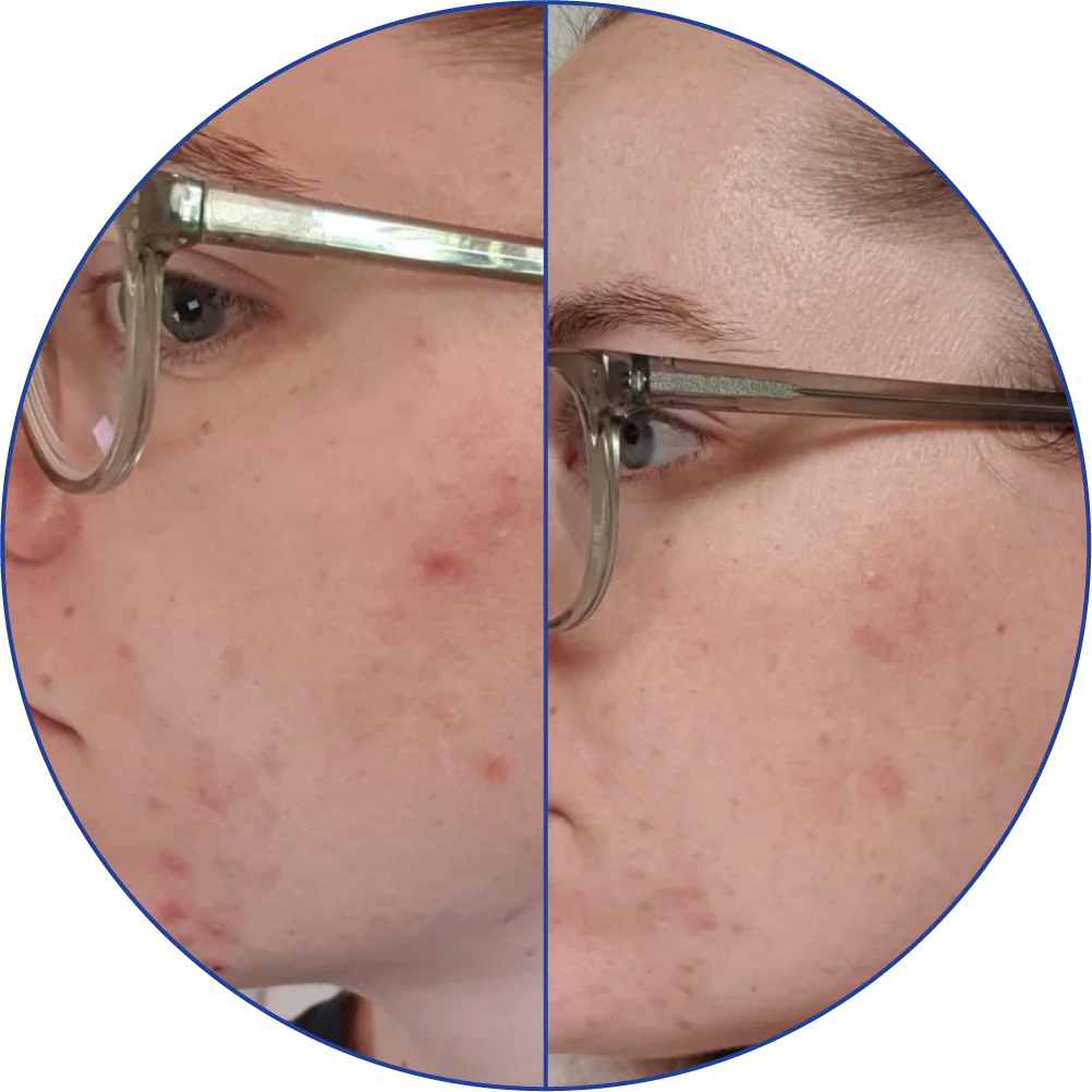 Side-by-side comparison of facial skin with acne before and after treatment.