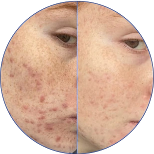 Close-up of a face with acne, before and after treatment comparison.
