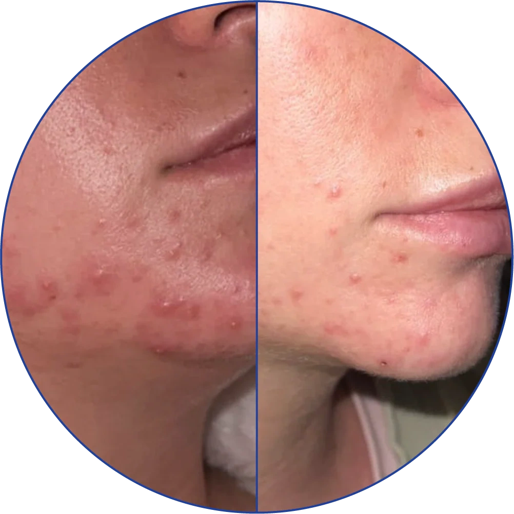Side-by-side comparison of acne-affected skin before and after treatment.