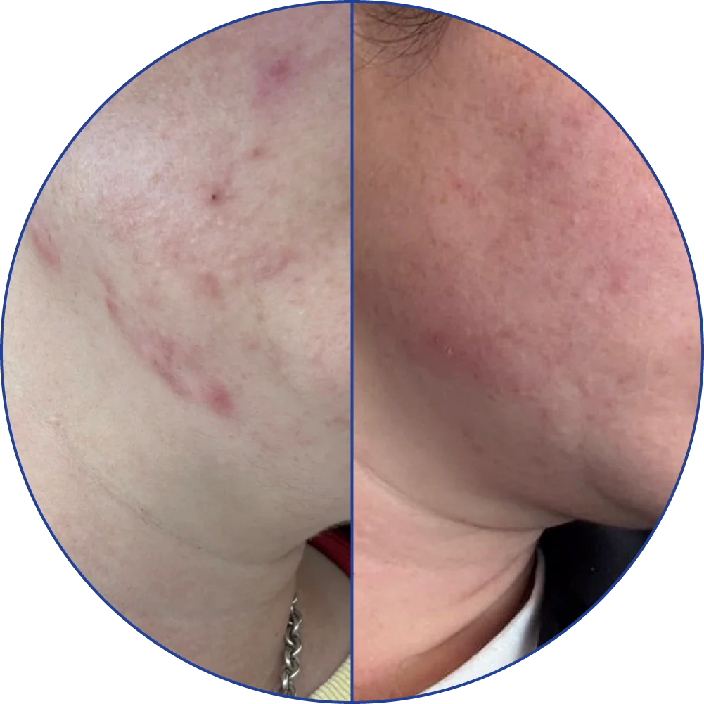 Side-by-side comparison of facial skin with redness and clearer complexion.