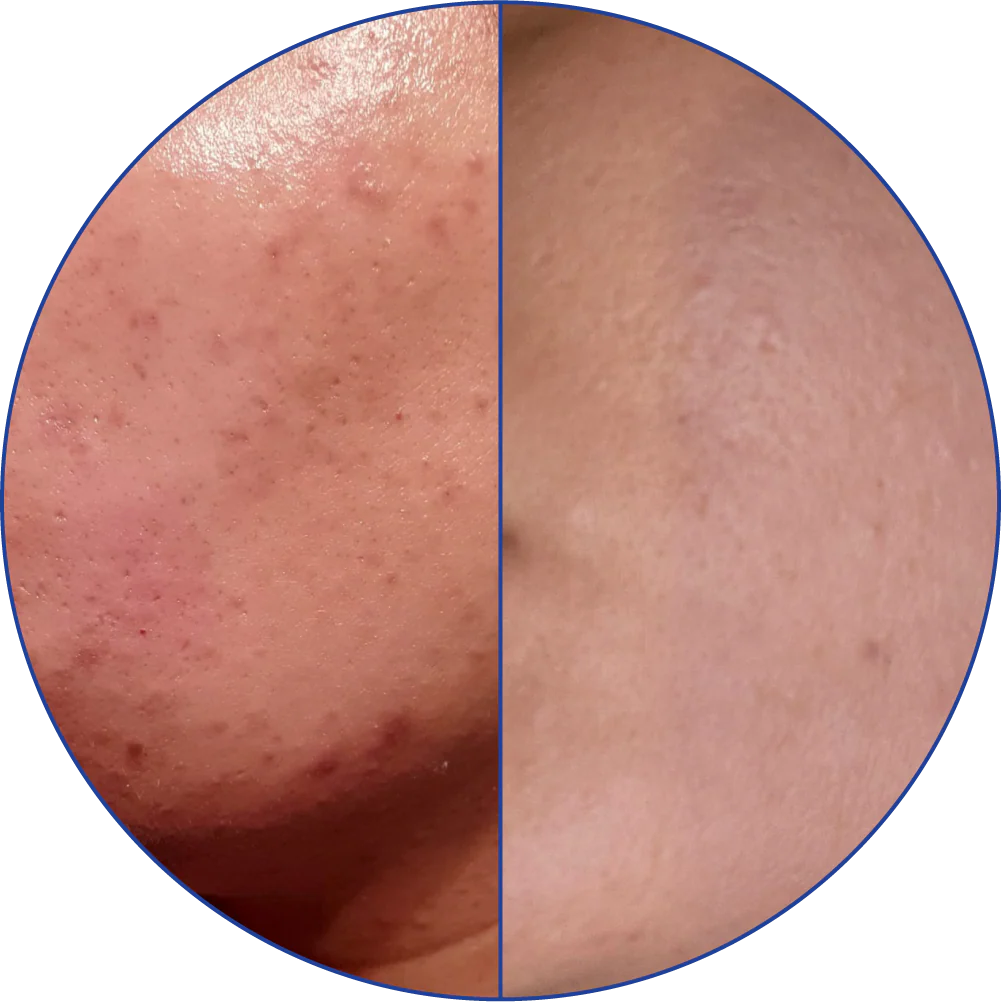 Close-up of skin with visible pores on the left and smoother texture on the right.