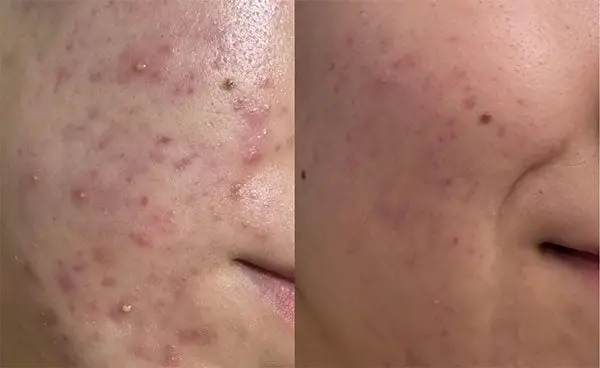 Side-by-side comparison of skin with acne before and after treatment.