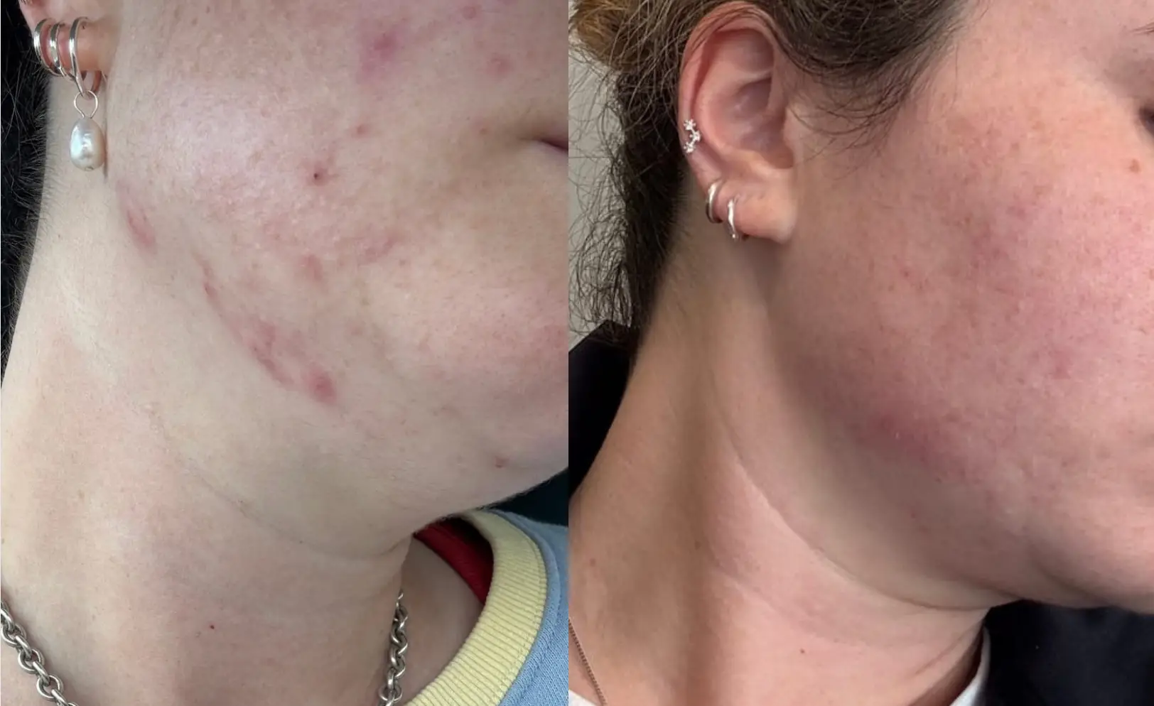 Side-by-side comparison of skin with acne marks and improved skin.