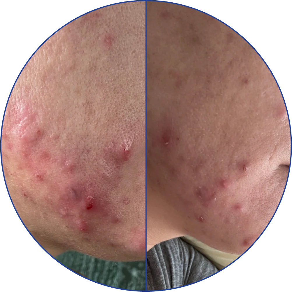 Side-by-side comparison of a person's cheek with acne before and after treatment.