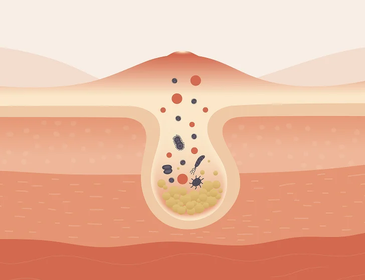 Illustration of a pimple with bacteria and cells inside a skin cross-section.