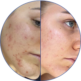 Comparison of facial skin before and after acne treatment.