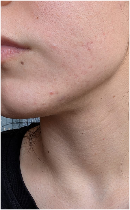 Skin Care After