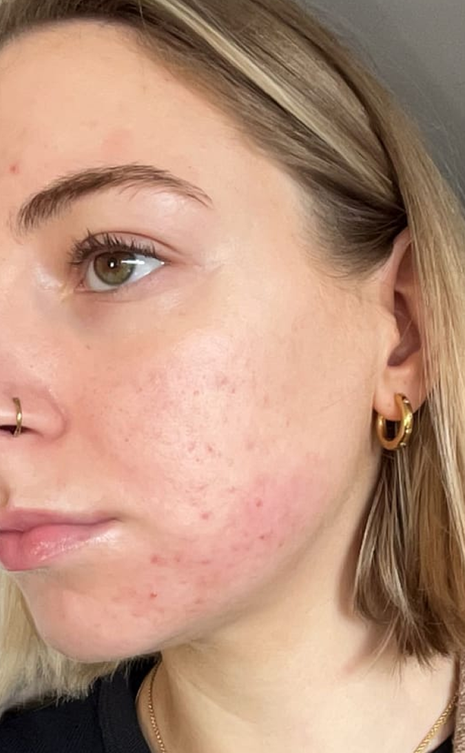 Skin Care Before