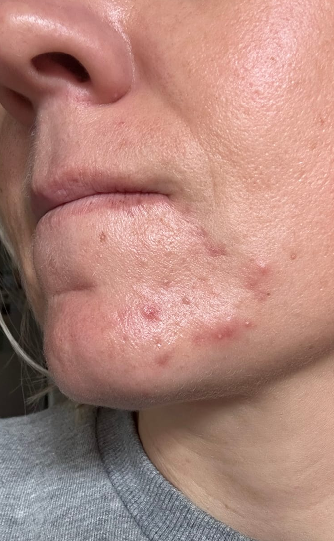 Skin Care Before