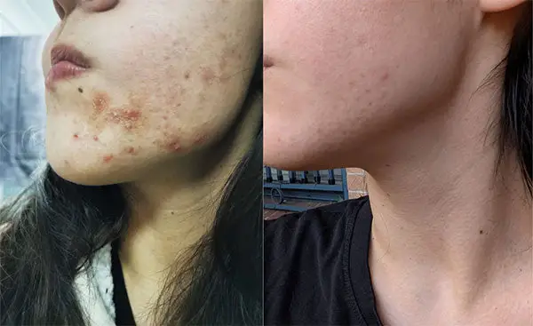 Two side-by-side images showing a person's cheek before and after acne treatment.