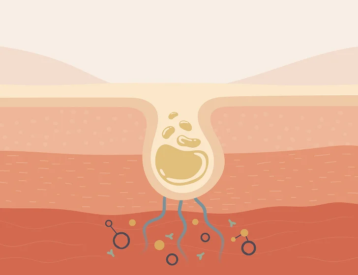 Illustration of a cross-section of a skin pore with oil and bacteria.