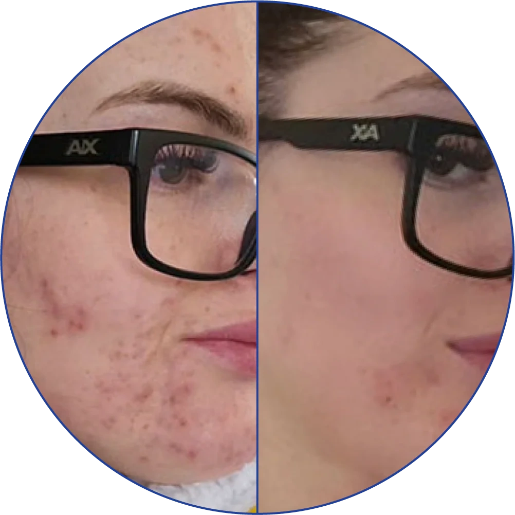 Split image showing close-ups of a face with and without acne.