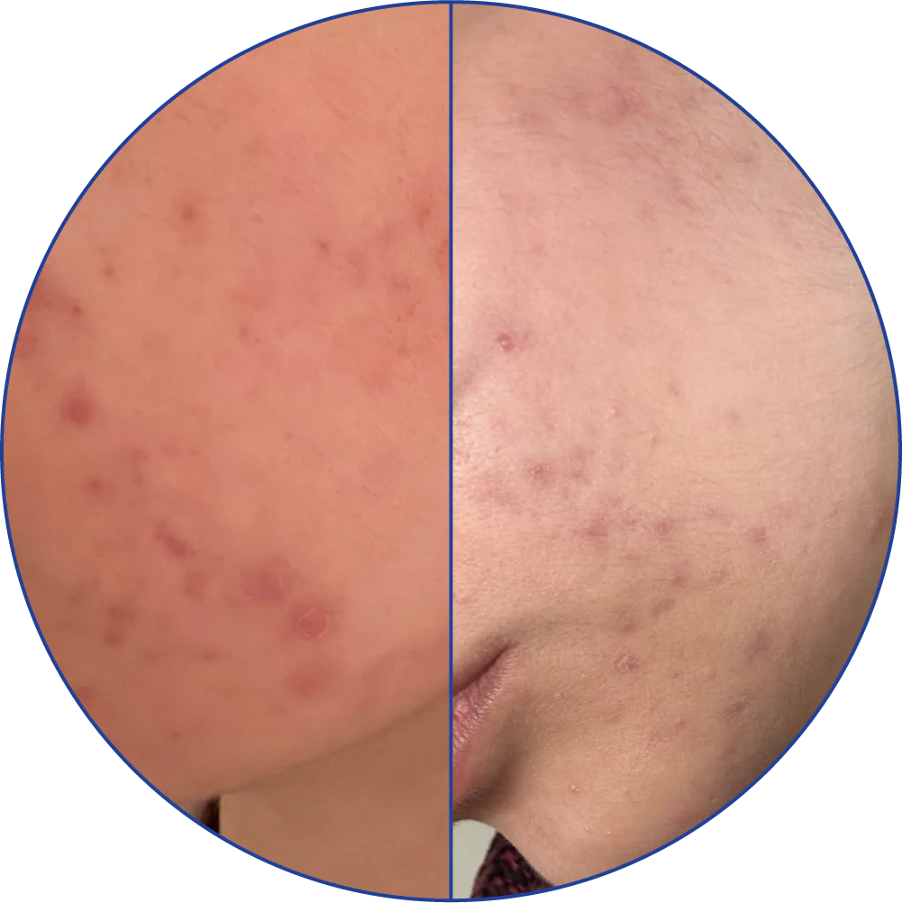 Comparative image showing facial skin with acne before and after treatment.