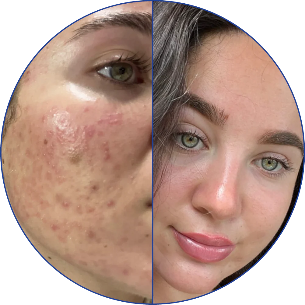 Side-by-side image of a woman's face, before and after skincare.