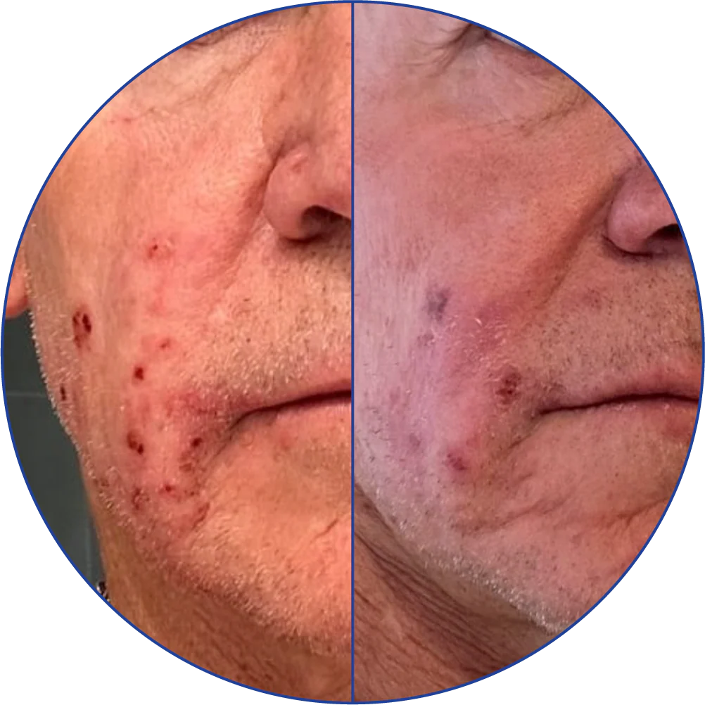 Side-by-side comparison of a man's face before and after skin treatment.
