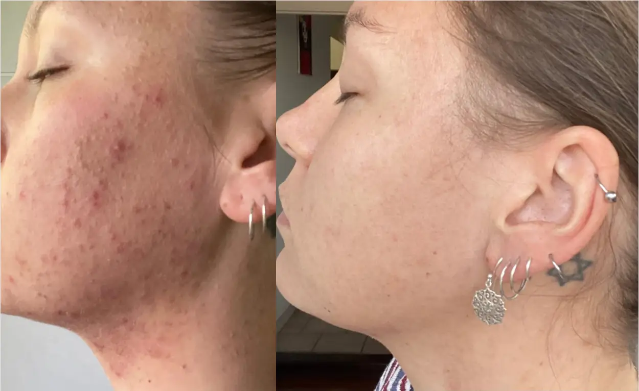 Side-by-side comparison of a face with acne and clear skin.