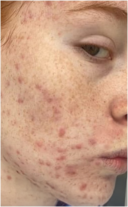 Skin Care Before