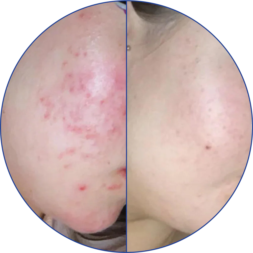 Side-by-side comparison of facial acne before and after treatment.