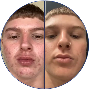 Split image of a person with acne before and after treatment.