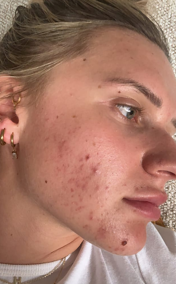 Skin Care Before
