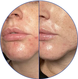 Side-by-side comparison of skin with and without blemishes on a person's face.