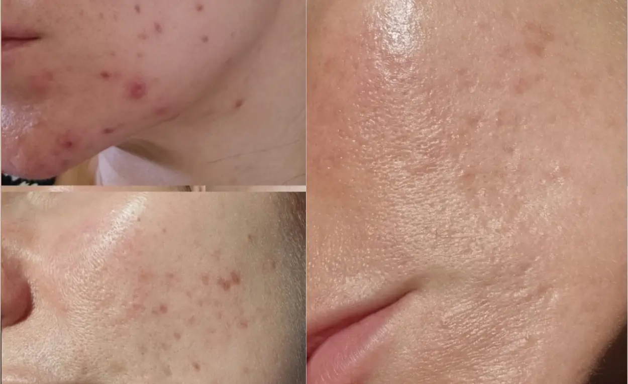 Three close-up images of facial skin with acne and scars.