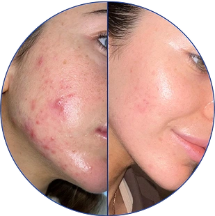 Side-by-side comparison of acne-prone skin before and after treatment.