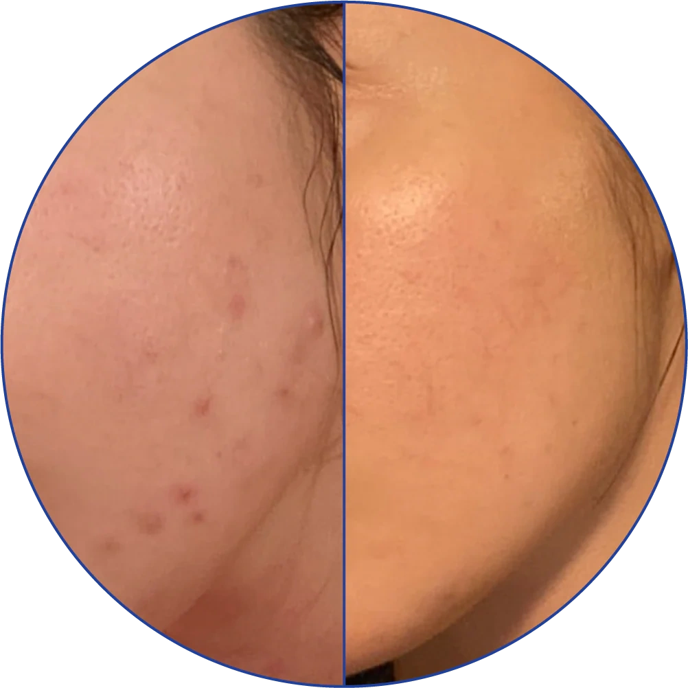 Side-by-side comparison of a cheek before and after skin treatment.