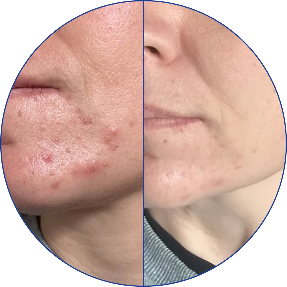 Side-by-side comparison of chin with acne and clear skin.