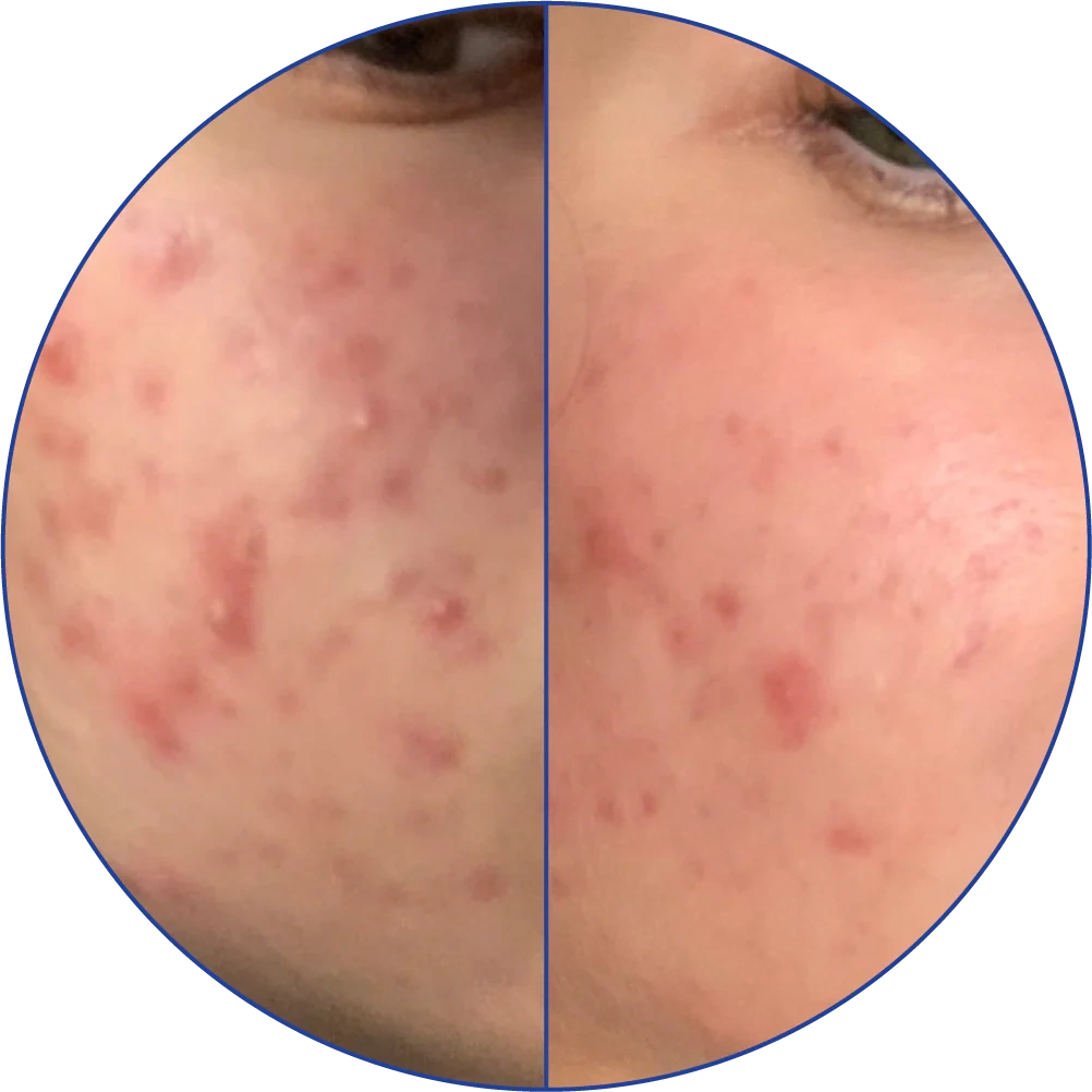 Close-up comparison of facial skin with acne before and after treatment.