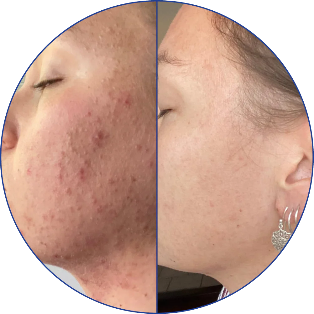Side-by-side comparison of facial skin before and after treatment.