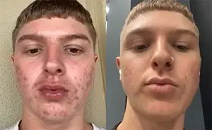 Two close-up selfies of a person with different facial expressions.