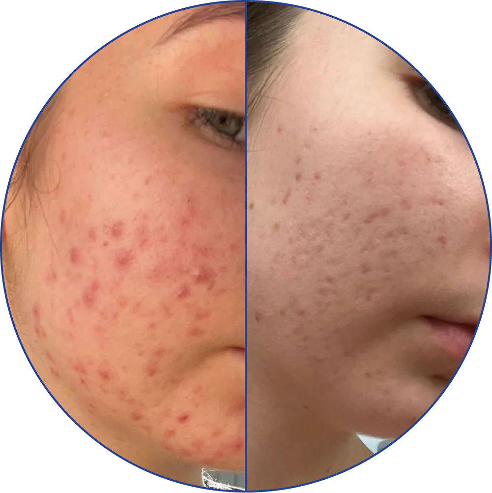 Comparison of acne on a cheek before and after treatment.