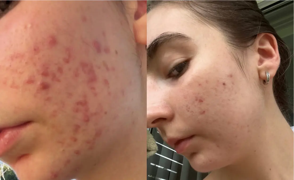 Close-up of two faces with acne on their cheeks.