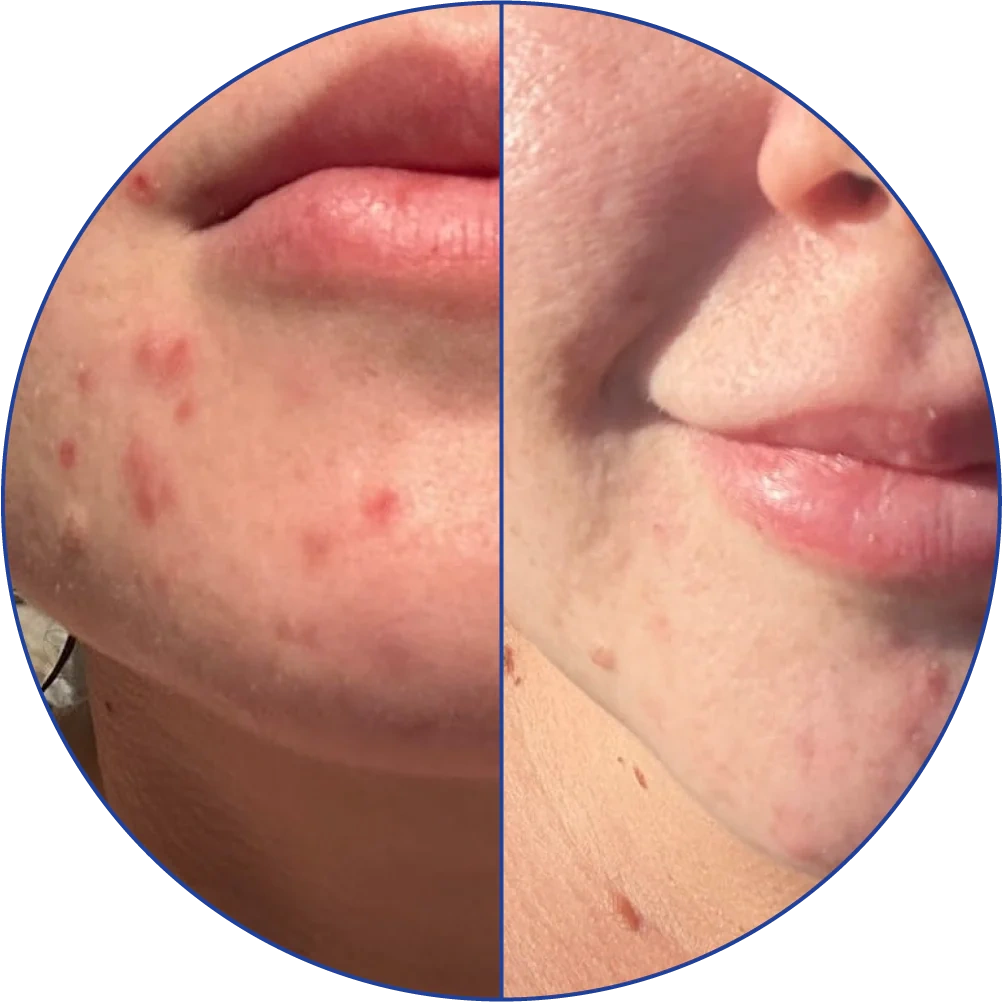 Comparison of facial skin with and without acne.