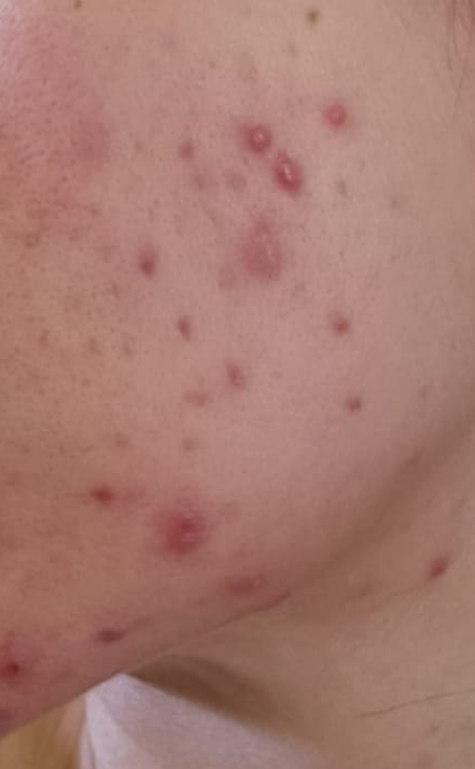 Skin Care Before