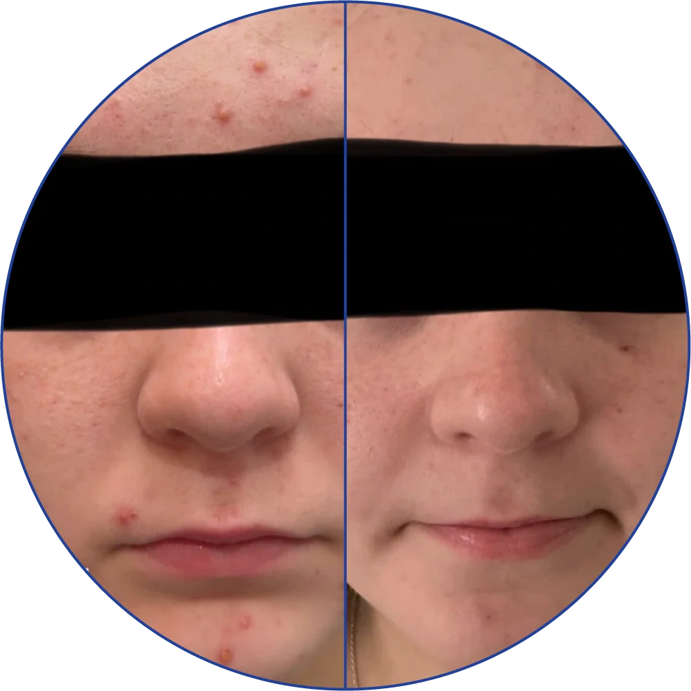 Side-by-side comparison of facial skin with and without acne blemishes.