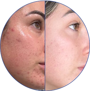 Side-by-side comparison of facial skin before and after treatment.