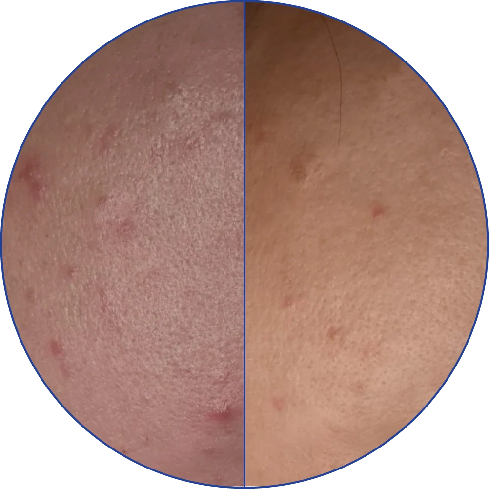 Close-up comparison of skin showing improvement from acne to clearer texture.