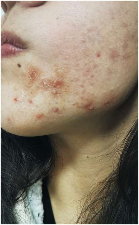 Skin Care Before