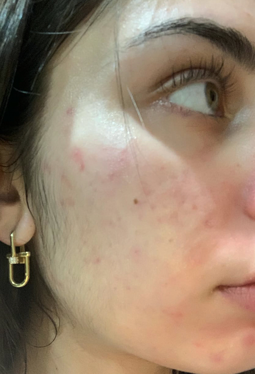 Close-up of a person's cheek with acne and wearing a gold earring.